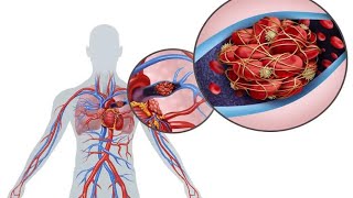 Investigation of pulmonary embolism by Wells score مخطط بالعربي [upl. by Elstan]