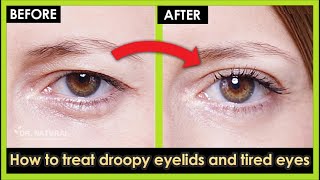 How to treat Droopy eyelids Sagging eyelids and Tired eyes Naturally at home 100 Work [upl. by Redd]