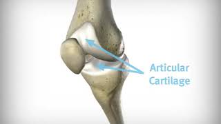 Gonartrosis Artrosis de Rodilla Evolución Zimmer Biomet®  SurgicalNet  IQ [upl. by Archangel]