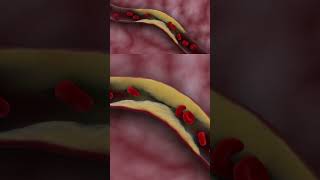 Thrombotic ischemic stroke doctor science biology film4health hospital [upl. by Burrows878]