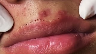 Lips Blackhead removal Video 53 Blackheads blackheadsremoval sebum [upl. by Nnahgiel]