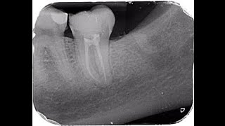 LIVE ENDODONTIC TREATMENT  Lower second left molar [upl. by Hamirak642]