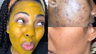 I Tried DIY Tumeric Mask For 3 Days And This Happened My Skin Feels like a Baby’s Butt [upl. by Ttevi]