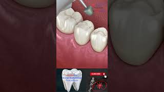 Dental Restoration ↪ Composite Bonding Teeth ↪ 3D Medical Animation [upl. by Nyrb536]