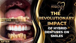 The Revolutionary Impact of Hybrid Dentures on Smiles [upl. by Ul]