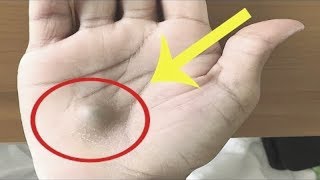 A Man Found This Strange Lump On His Palm Then A Scan Revealed The True Cause Of This [upl. by Trefler]