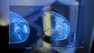 3D Mammography [upl. by Annahahs]