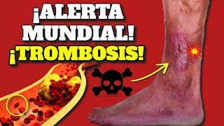 ¡ALERTA MUNDIAL SURGEN TROMBOSIS COÁGULOS y EMBOLIA SIGNOS DE ALARMA y COMO PREVENIR TROMBOS [upl. by Anyr]