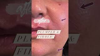 PRP and Vivace RF microneedling [upl. by Atyekram494]