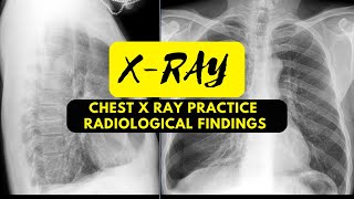 Chest X Ray Practice 37  Radiological Findings Bronchitis [upl. by Fadas]