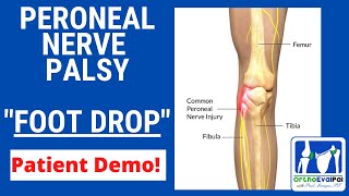 Peroneal Nerve Palsy with Foot Drop [upl. by Enirrok402]