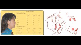 iAOI Case 6 Report by Dr Tseng  Severe Crowding Complicated by Missing Molars [upl. by Ingrim]