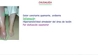 CAUSALGIA [upl. by Adam]