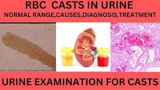 RBC CAST IN THE URINE CAUSES SYMPTOMS AND TREATMENT OF RBC CAST IN URINE EXAMINATION [upl. by Hershel]