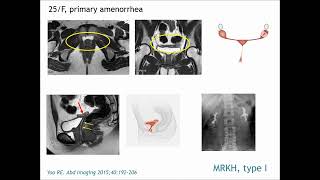 Mullerian duct anomaliestKRadiology Tutorial [upl. by Nowaj109]