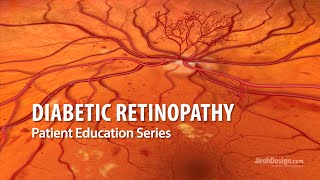 Diabetic Retinopathy [upl. by Lucy162]