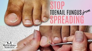 How to Stop Toenail Fungus from Spreading [upl. by Anaeed]