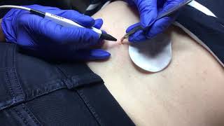 Skin Tag Removal using electrolysis advanced cosmetic procedures [upl. by Dielu]