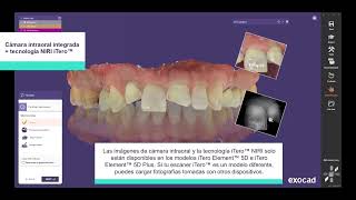 iTero™ Exocad Connector [upl. by Atina]