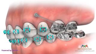 Temporary Anchorage Device or TAD  Orthodontic Appliance [upl. by Earehs]