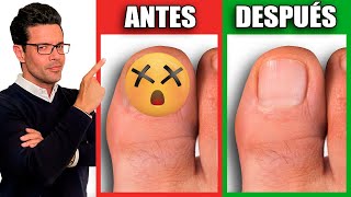 ¡Elimina HONGOS en las UÑAS en 1 DÍA  REMEDIOS NATURALES para HONGOS en las UÑAS [upl. by Anivel160]