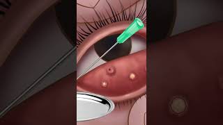 ASMR eye stone removal animation  Eyelid Sebum Extrusion Animation  Meibomian Gland Cleaning [upl. by Spohr]