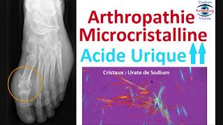 Arthropathie Microcristalline Dépôts des Cristaux dUrate de Sodium la Goutte [upl. by Keenan]