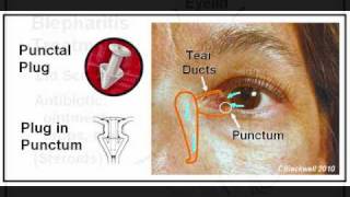 Dry Eye 2 Diagnosis and Treatment [upl. by Courtney]