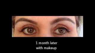 Blepharoplasty Upper eyelid lift surgery  recovery story [upl. by Wilburt]