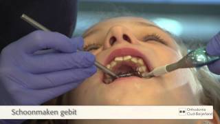 Plaatsen van een Expander Spin beugel  Orthodontie OudBeijerland [upl. by Curzon529]