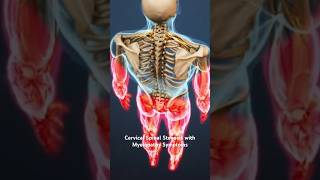 Cervical Spinal Stenosis with Myelopathy Symptoms [upl. by Stoll]