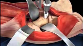 Total Hip Replacement Surgery [upl. by Reywas]