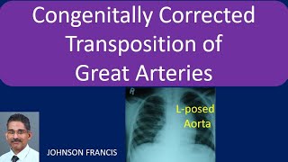 Congenitally Corrected Transposition of Great Arteries [upl. by Ynned]