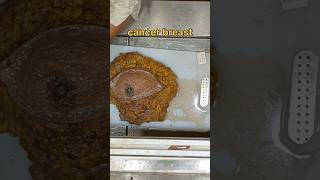 Carcinoma breast cancer breast specimen [upl. by Hayarahs]