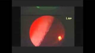 Laser Turbinoplasty  Treatment for Chronic Nose Block [upl. by Nerita758]