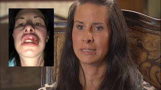 Mother shares warning after lip augmentation nightmare [upl. by Ojaras653]