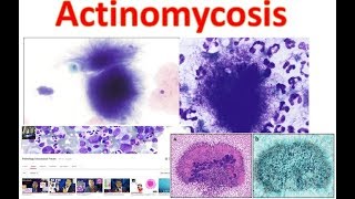 Actinomycosis Medschooltutorial [upl. by Yursa]