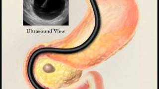 Endoscopic Ultrasound with Fine Needle Aspiration Biopsy [upl. by Caro]