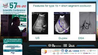 BuddChiari Syndrome Imaging Features and Radiological Interventions [upl. by Saville611]