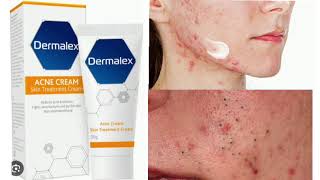 Dermalex Acne Treatment Cream [upl. by Ainotna]