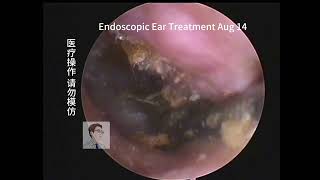 Cerumen cleaning of artificially excavated narrow ear canals，20230814 [upl. by Adamik]