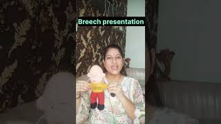 Breech presentation normal delivery or caesareanmedicalpregnant [upl. by Darraj]