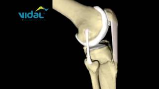 Ligamento Colateral Lateral flexão  Vidal [upl. by Akined]