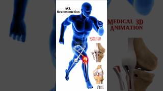 ACL Reconstruction medical animation 3d short Biology with Aliya [upl. by Aneelak]