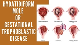 Hydatidiform Mole  Vesicular Mole  Molar Pregnancy  Gestational Trophoblastic Disease [upl. by Aiksa]