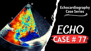 ECHO CASE 77  Echocardiography Spot Diagnosis Series  Echocardiogram Interpretation [upl. by Okoyik]