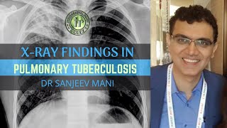 PULMONARY TUBERCULOSIS  XRAY FINDINGS  DR SANJEEV MANI  MILIARY MOTTLING  ROLE OF IMAGING IN TB [upl. by Aramaj875]