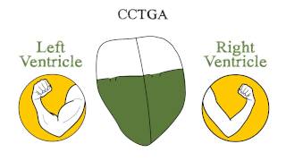 Congenitally Corrected Transposition of the Great Arteries CCTGA [upl. by Ier448]