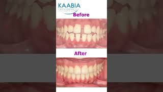 Bimaxillary protrusion  open bite and diastema [upl. by Ytsirhc477]