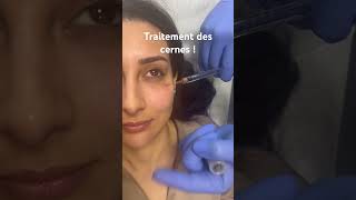 Traitement des cernes par acidehyaluronique raspaldo regard medecineesthetique [upl. by Garson]